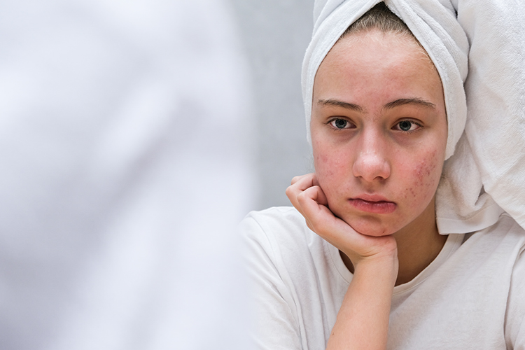 can birth control help acne